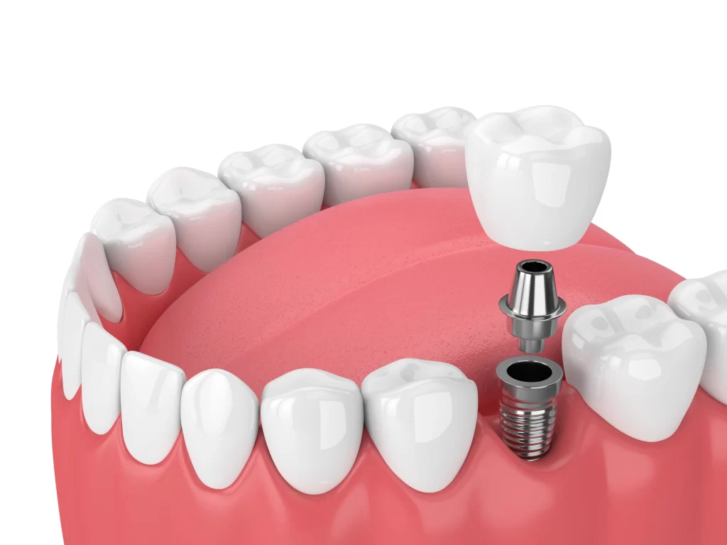 Dental Implants Services