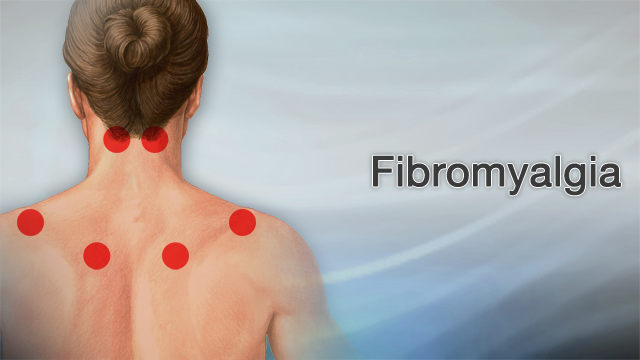 fibromyalgia