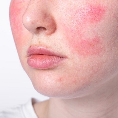 Skin Harmony: A Deep Dive into Rosacea Treatment Techniques