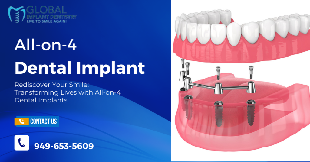 All-on-4 Dental Implants?