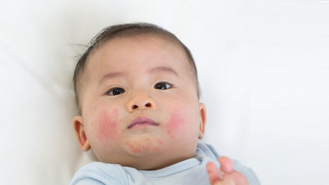 eczema