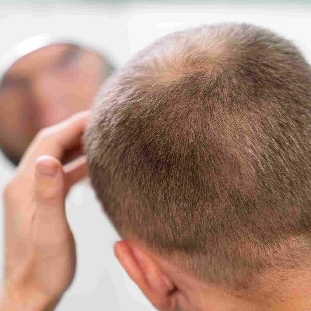 One Session Regenara Activa in Riyadh for Hair Loss & Baldness