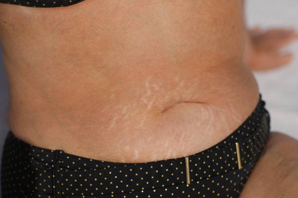 stretch marks removal in Abu Dhabi