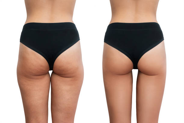 Cellulite Removal Treatment in Abu Dhabi