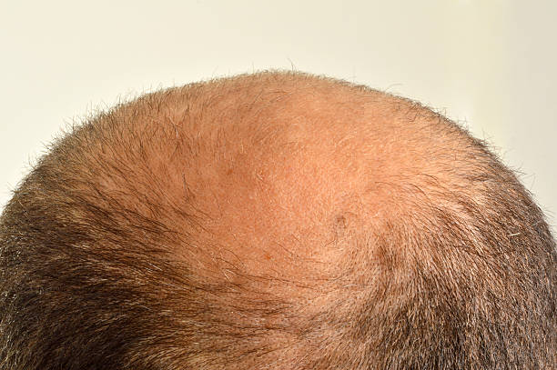 Hair Loss Treatments in Abu Dhabi