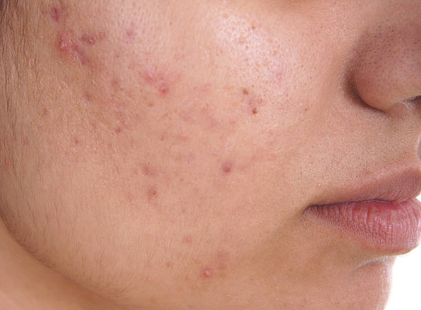 acne treatment in Abu Dhabi