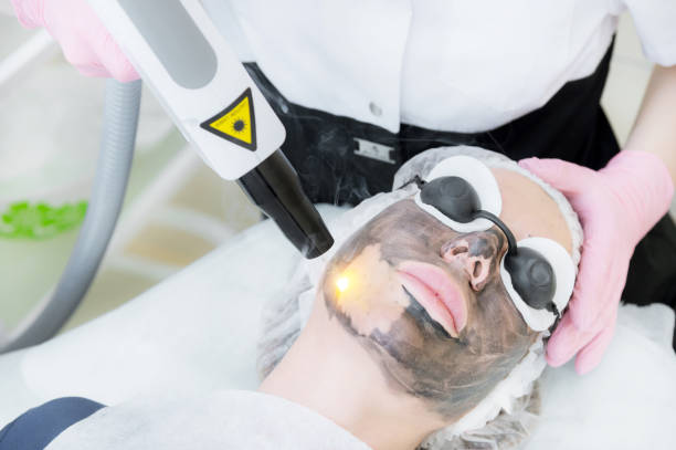 Laser Carbon Peel in Abu Dhabi