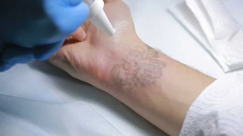 Can Laser Tattoo Removal Completely Erase a Tattoo?