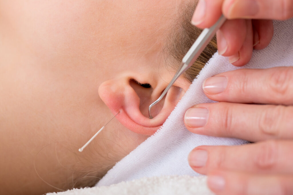 Ear Acupuncture