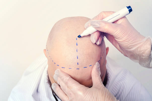 hair transplant in Abu Dhabi