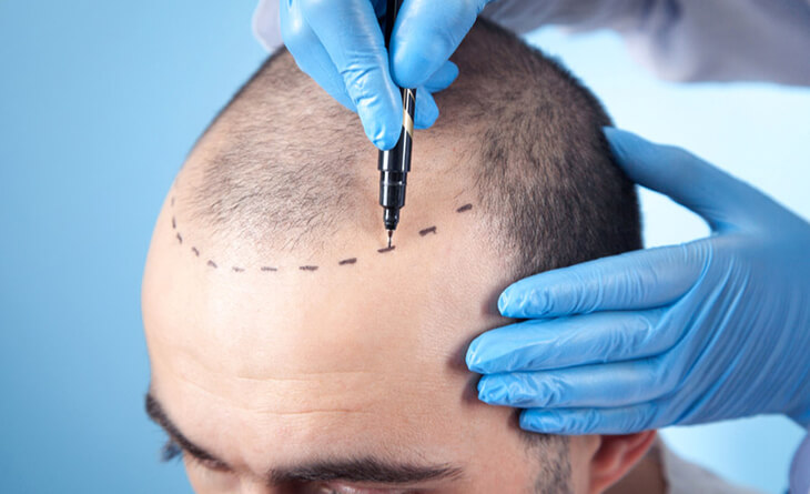 Hair Transplant surgery