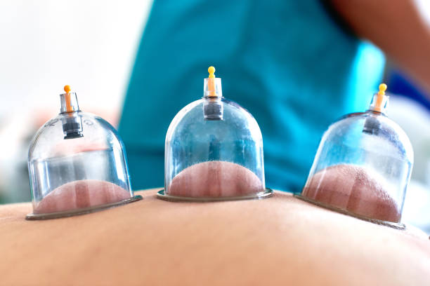 Hijama treatment in Abu Dhabi