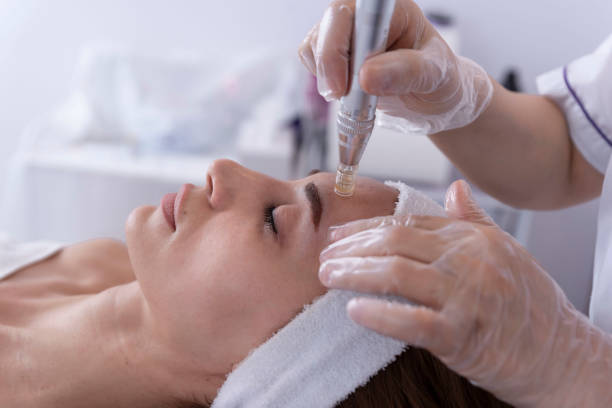 Fractional RF Micro Needling in Abu Dhabi