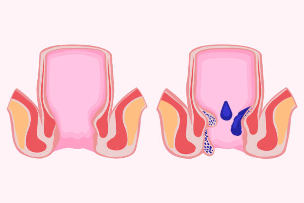 Hemorrhoid Treatment in Al Ain