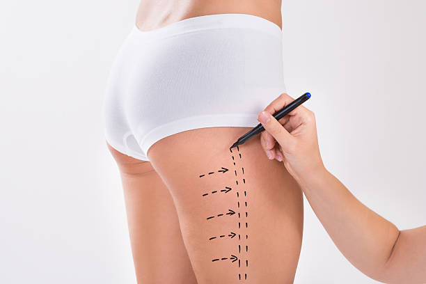 Thigh Liposuction Cost