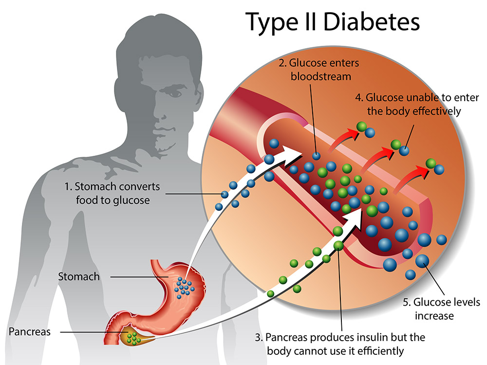 HCQS 400mg: Your Partner in Diabetes Control