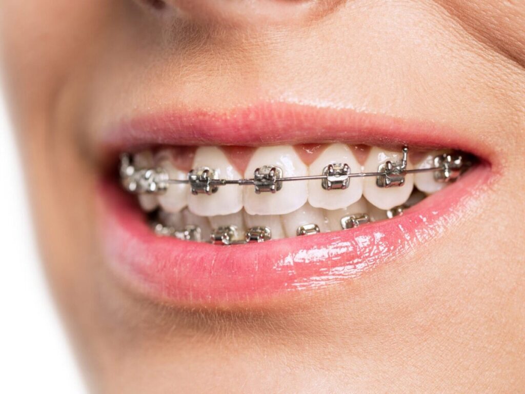 dental implants and braces