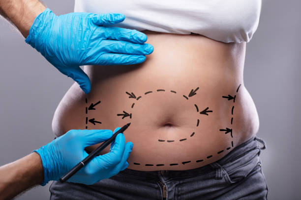 Liposuction Cost UAE