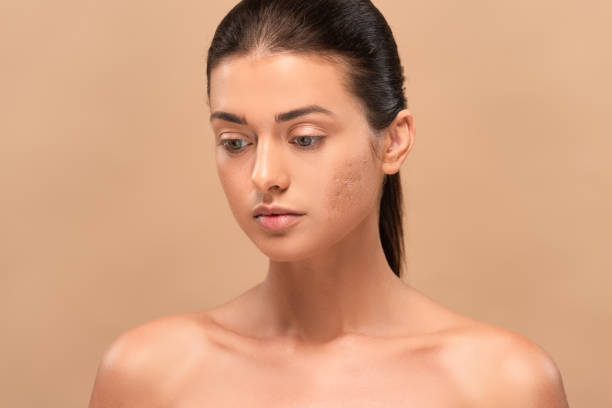 acne treatment in Abu Dhabi