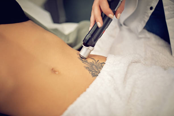 laser tattoo removal in Abu Dhabi