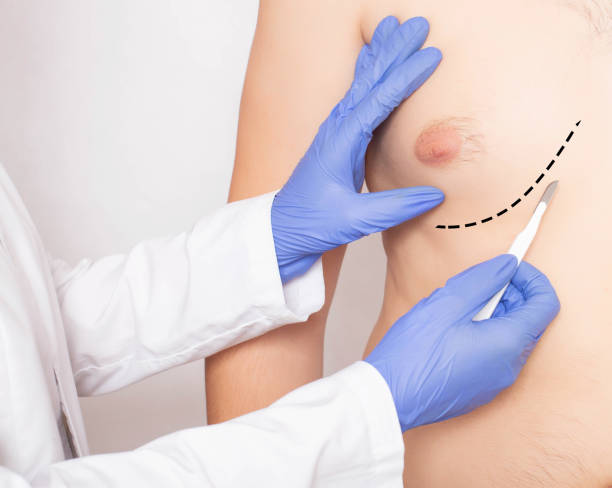 Gynecomastia in Al Ain