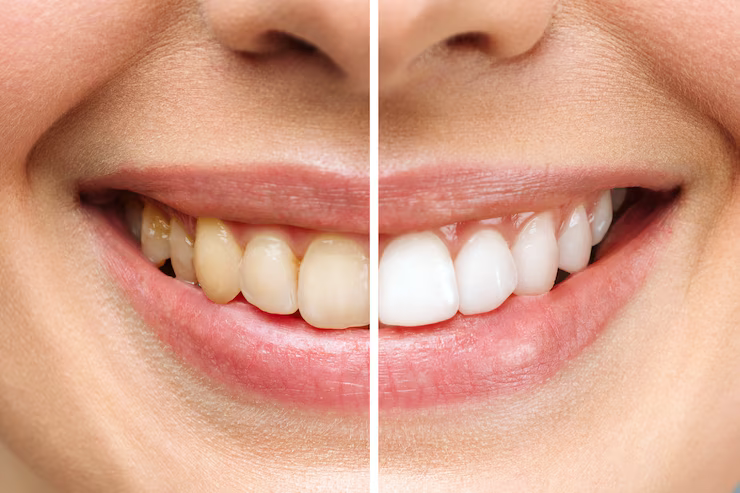 teeth whitening louisville ky