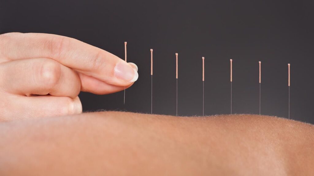 What Are the Benefits of Local Acupuncture for Wellness