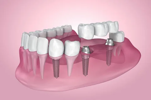 Dental Implants Leichhardt