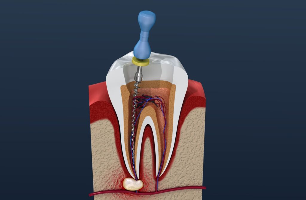 tooth root canal